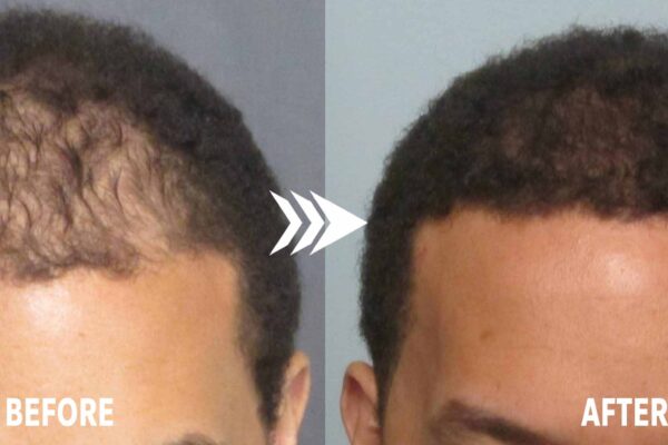 Inside Ghana’s Growing Hair Transplant Industry