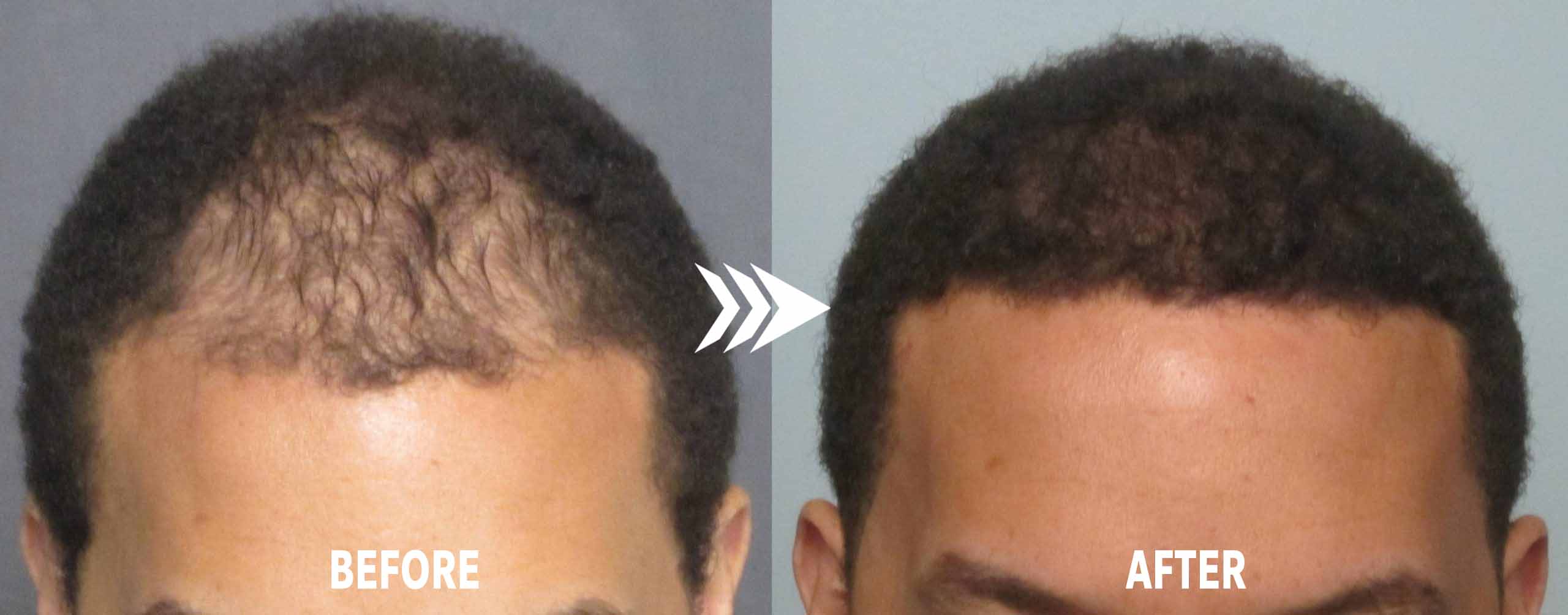 Inside Ghana’s Growing Hair Transplant Industry